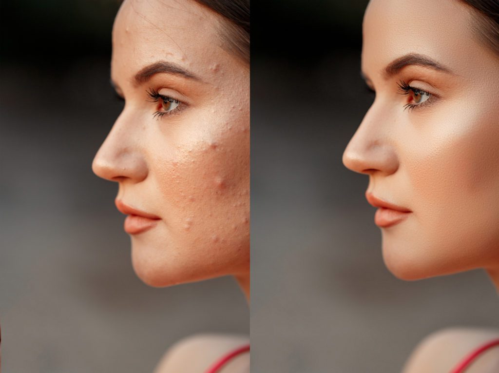 Before and after acne treatment. Photo on the left shows woman before acne treatment. Photo on right shows after acne treatment
