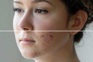 Before and after treatment for acne scars