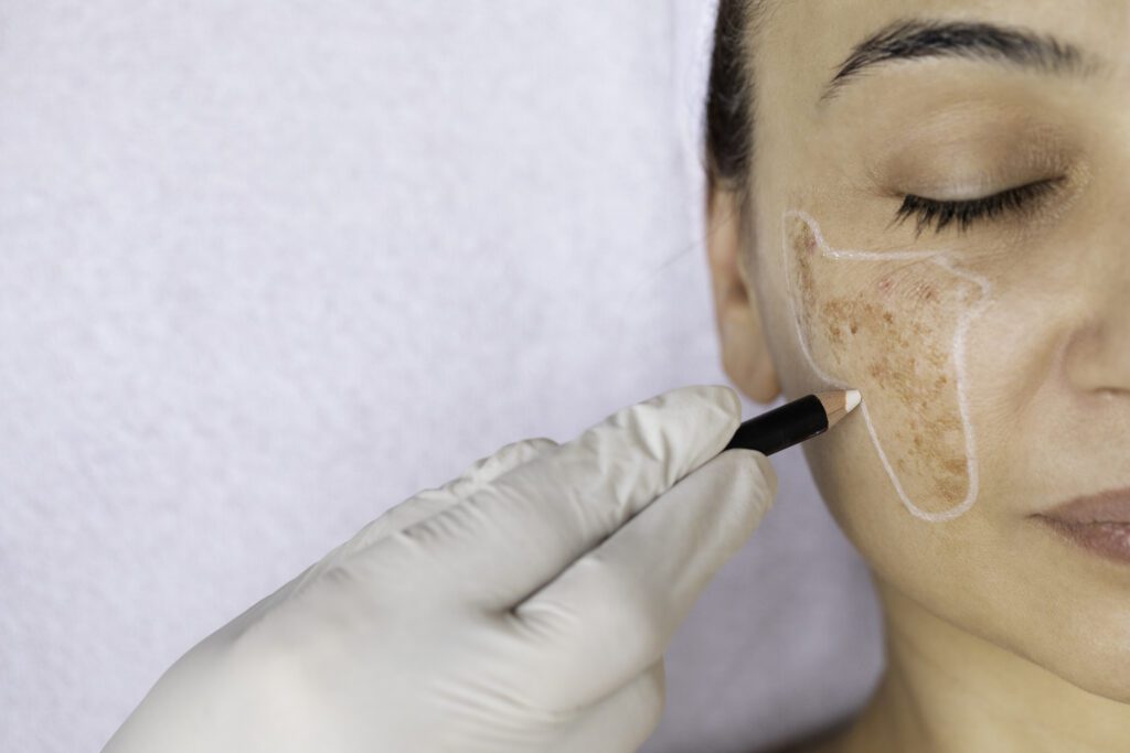 What is hyperpigmentation?